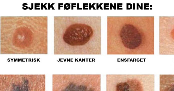 farlige føflekker farlige føflekker